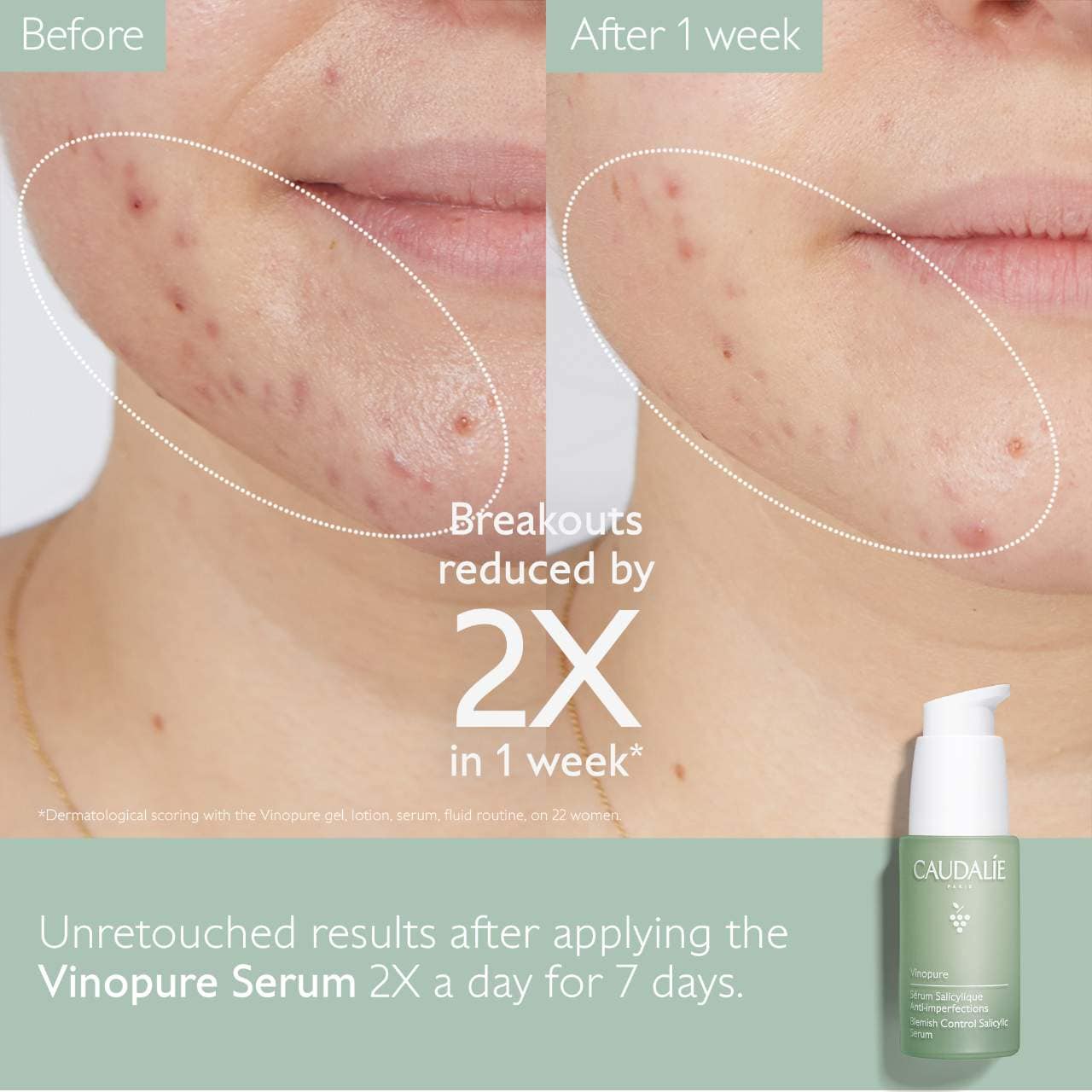 Vinopure Natural Salicylic Acid Pore Minimizing Serum (Suero Facial)