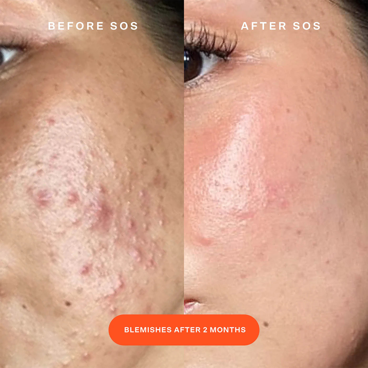 SOS Daily Rescue Facial Spray with Hypochlorous Acid (Suero Facial)