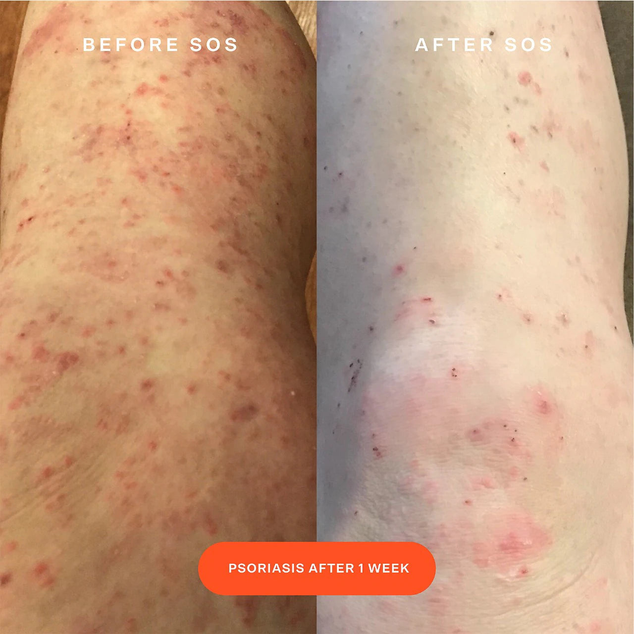SOS Daily Rescue Facial Spray with Hypochlorous Acid (Suero Facial)