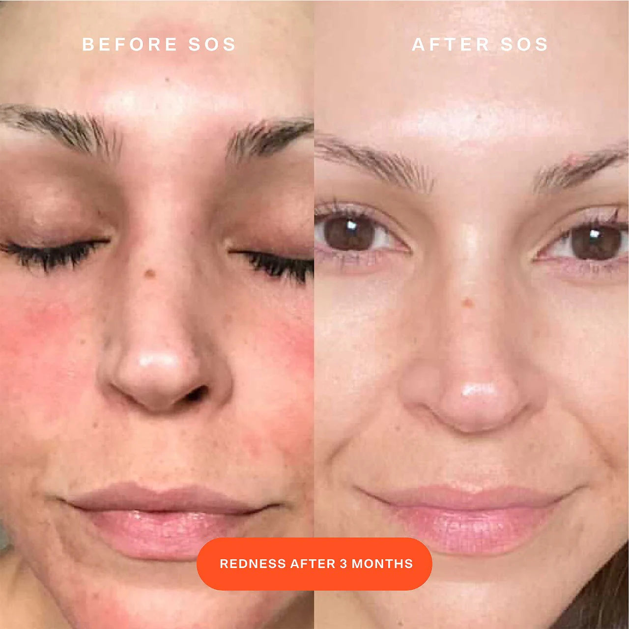 SOS Daily Rescue Facial Spray with Hypochlorous Acid (Suero Facial)