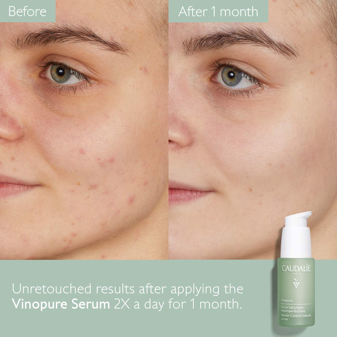 Vinopure Natural Salicylic Acid Pore Minimizing Serum (Suero Facial)
