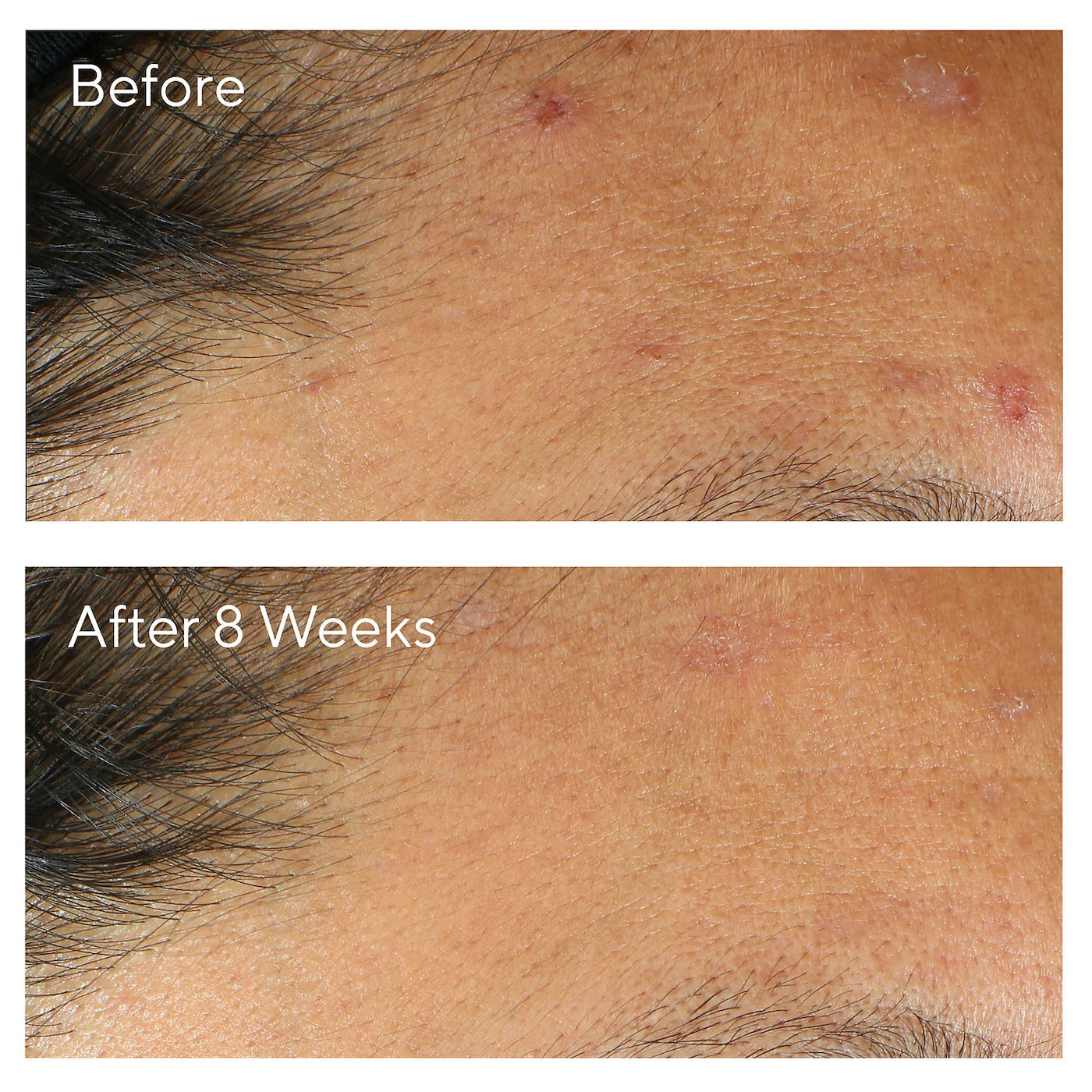 InvisiScar Post-Acne Resurfacing Treatment (Crema Facial)