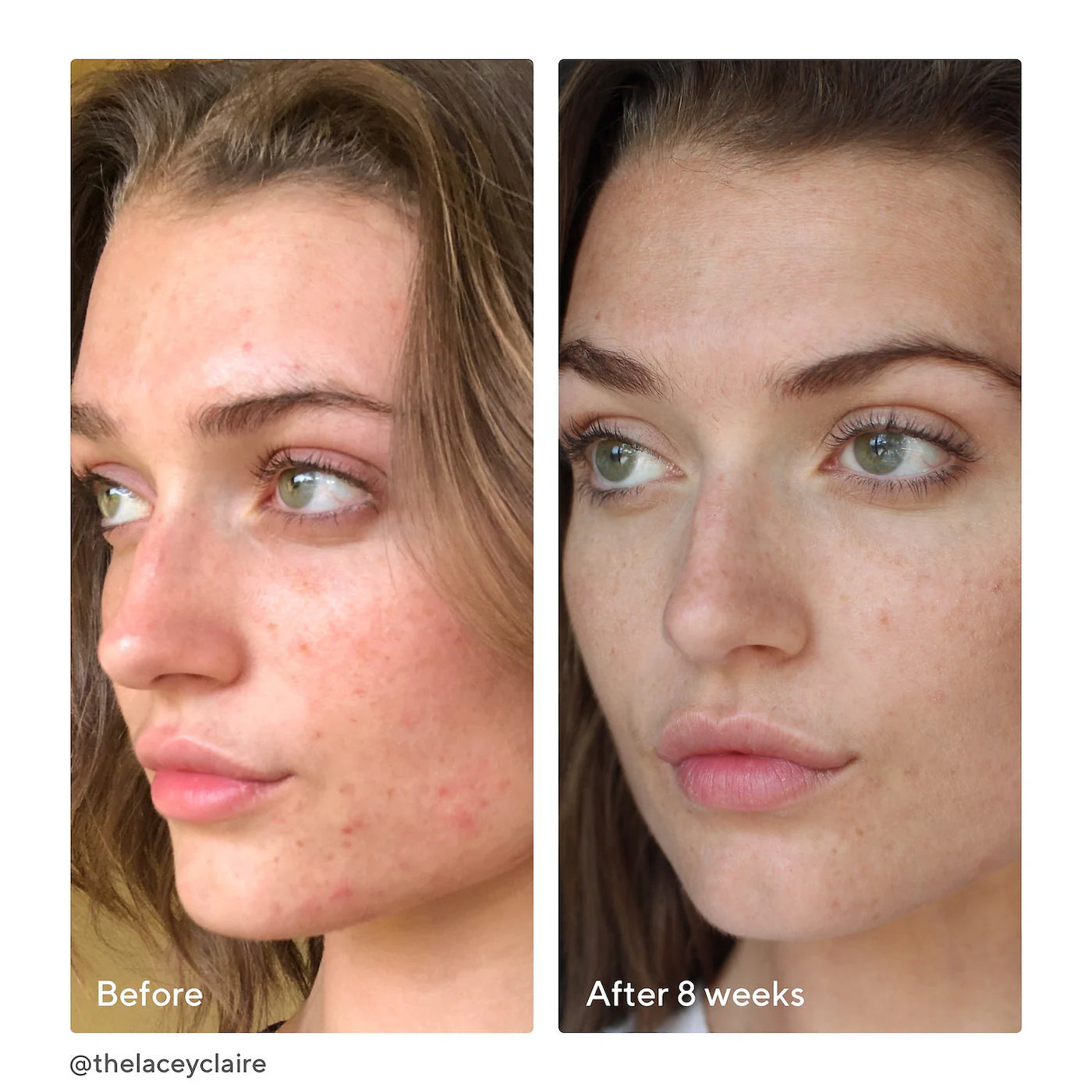 InvisiScar Post-Acne Resurfacing Treatment (Crema Facial)