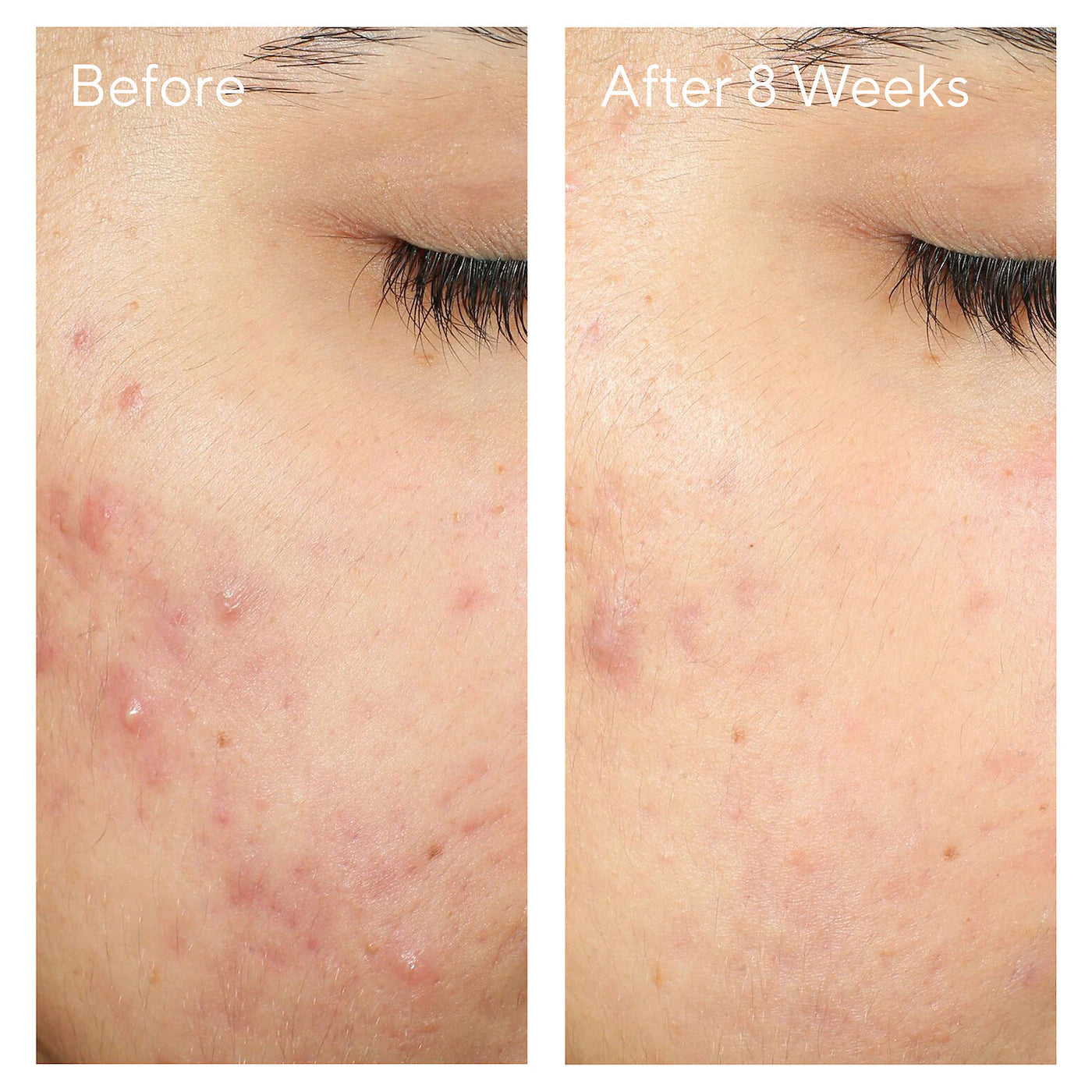 InvisiScar Post-Acne Resurfacing Treatment (Crema Facial)