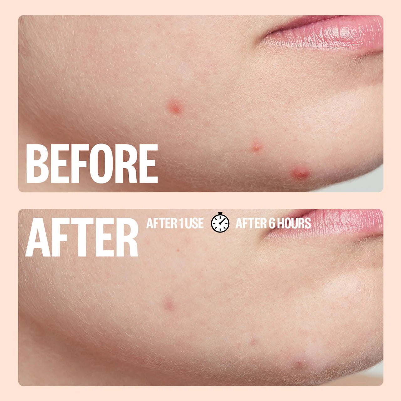 Salicylic Acid Acne Healing Dots (Parches Para Acné)