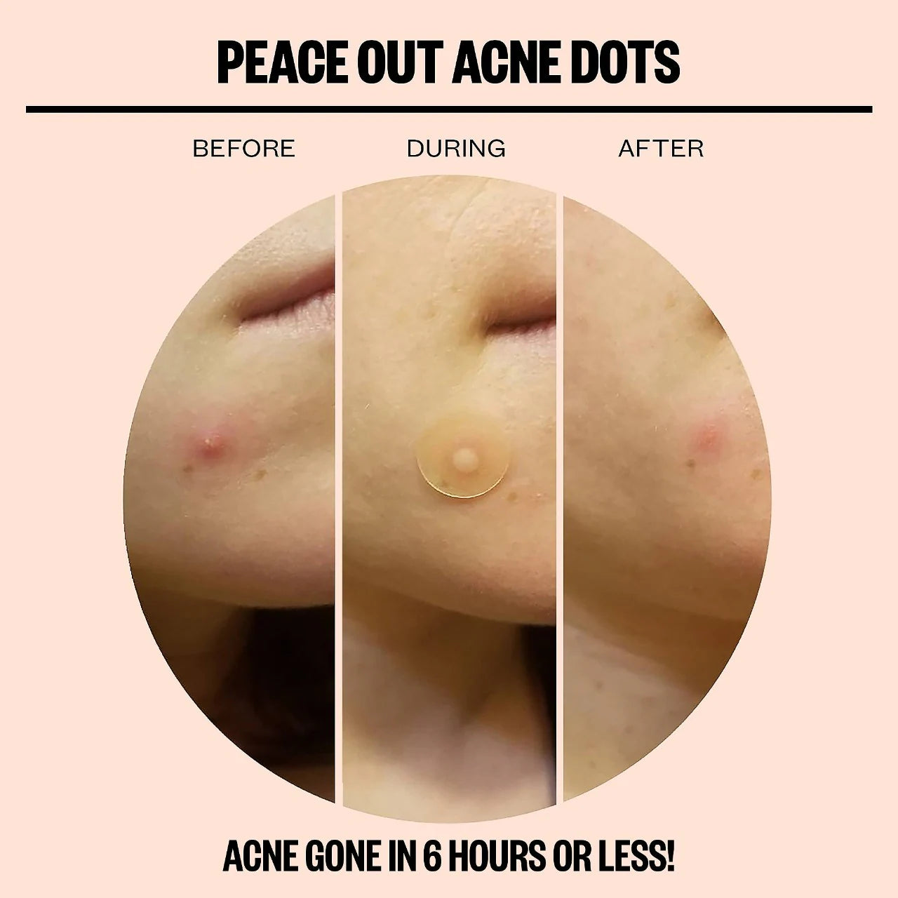 Salicylic Acid Acne Healing Dots (Parches Para Acné)