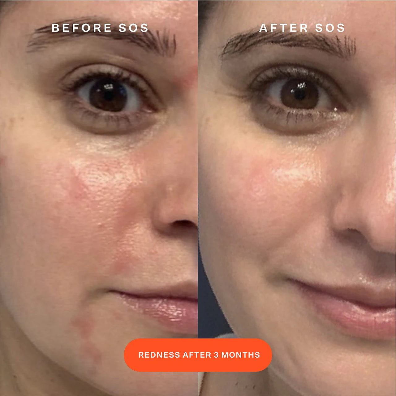 SOS Daily Rescue Facial Spray with Hypochlorous Acid (Suero Facial)