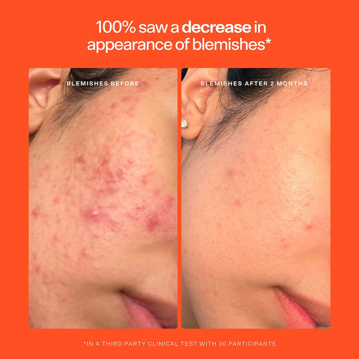 SOS Hypochlorous Acid Spray Duo Skincare (Kit o Set)