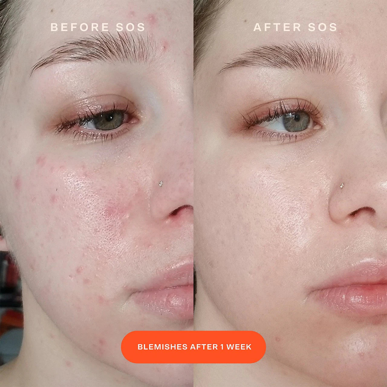 SOS Intensive Redness Relief Serum with Hypochlorous Acid (Suero Facial)